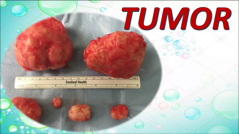 Презентация на тему "TUMOR" - Скачать школьные презентации PowerPoint бесплатно | Портал бесплатных презентаций school-present.com