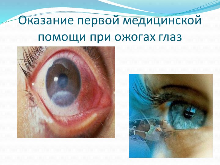 Презентация на тему: "Оказание первой медицинской помощи при ожогах глаз" - Скачать школьные презентации PowerPoint бесплатно | Портал бесплатных презентаций school-present.com