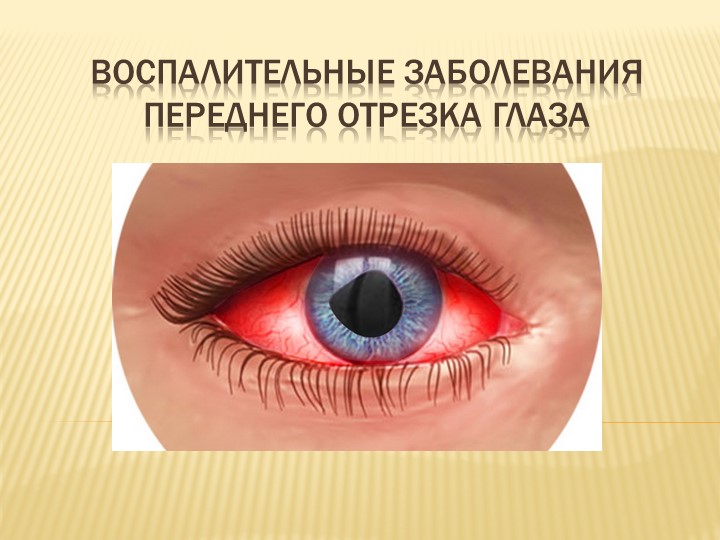 Презентация на тему "Воспалительные заболевания переднего отрезка глаза" - Скачать школьные презентации PowerPoint бесплатно | Портал бесплатных презентаций school-present.com